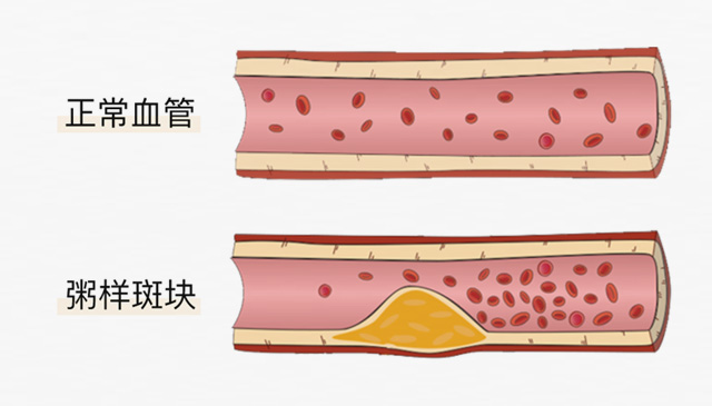 血栓是心梗、腦梗的元兇，很容易找上這些人