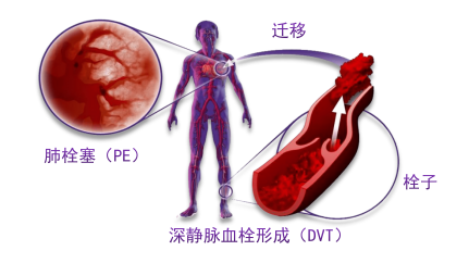 骨科術(shù)后重點(diǎn)關(guān)注的問題—VTE，該如何防治？