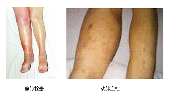動(dòng)脈血栓和靜脈血栓有什么區(qū)別嗎？