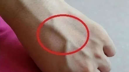 有人手臂上“青筋暴起”，有人卻看不到“青筋”，這是咋回事？