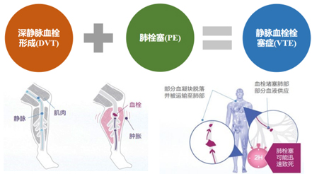 躺著也能防血栓？神經(jīng)肌肉電刺激來幫忙
