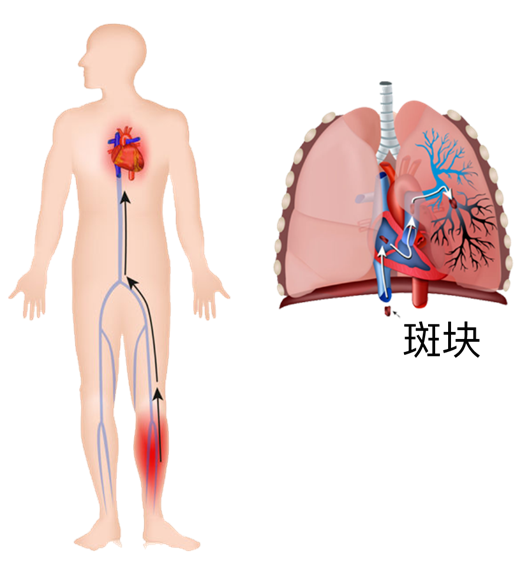 血栓是心梗、腦梗的元兇，很容易找上這些人
