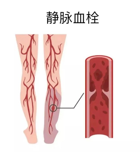 血栓是心梗、腦梗的元兇，很容易找上這些人