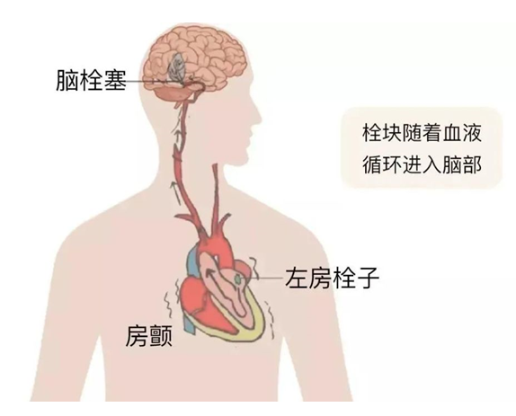 血栓是心梗、腦梗的元兇，很容易找上這些人