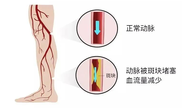 血栓是心梗、腦梗的元兇，很容易找上這些人
