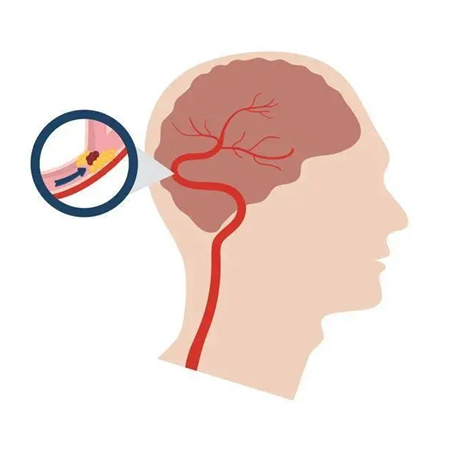 血栓是心梗、腦梗的元兇，很容易找上這些人