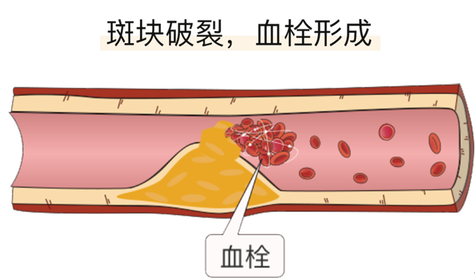血栓是心梗、腦梗的元兇，很容易找上這些人