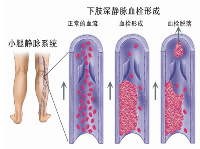 警惕！這個全球“第三大心血管殺手”，我們該如何應(yīng)對？