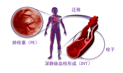 骨科術(shù)后重點關(guān)注的問題—VTE，該如何防治？