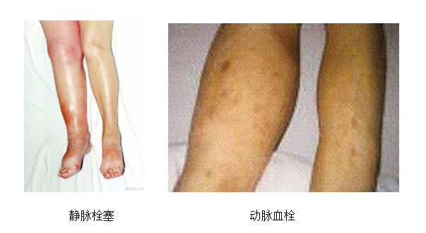 動脈血栓和靜脈血栓有什么區(qū)別嗎？
