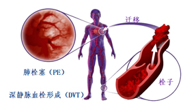 血栓疾病當警惕 日常預(yù)防要重視