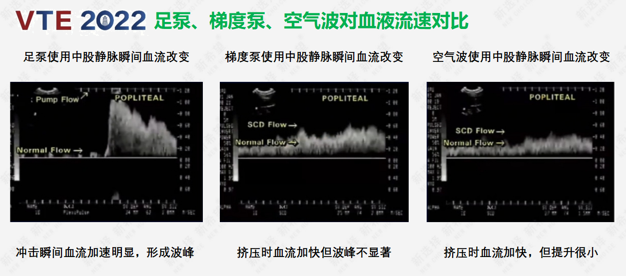 圍術(shù)期患者VTE的預(yù)防，只知道抗凝可不行