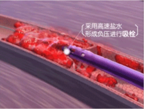 深靜脈血栓能致命，防治“大法”要了解！