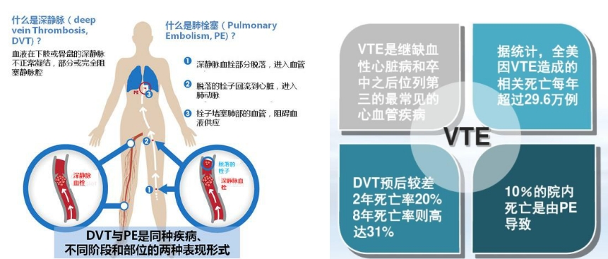 VTE的危害您了解嗎？