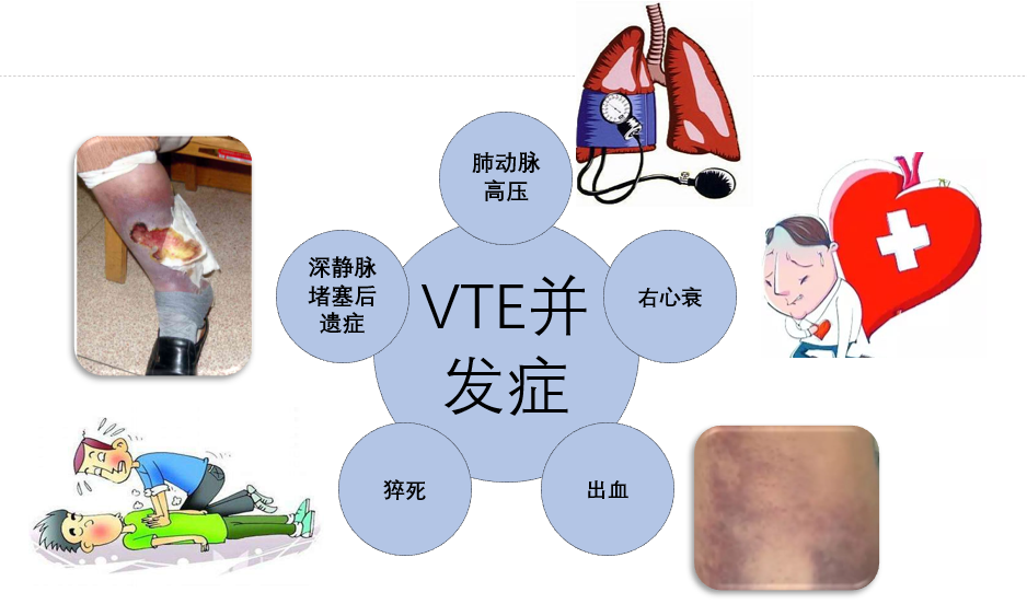 VTE的危害您了解嗎？